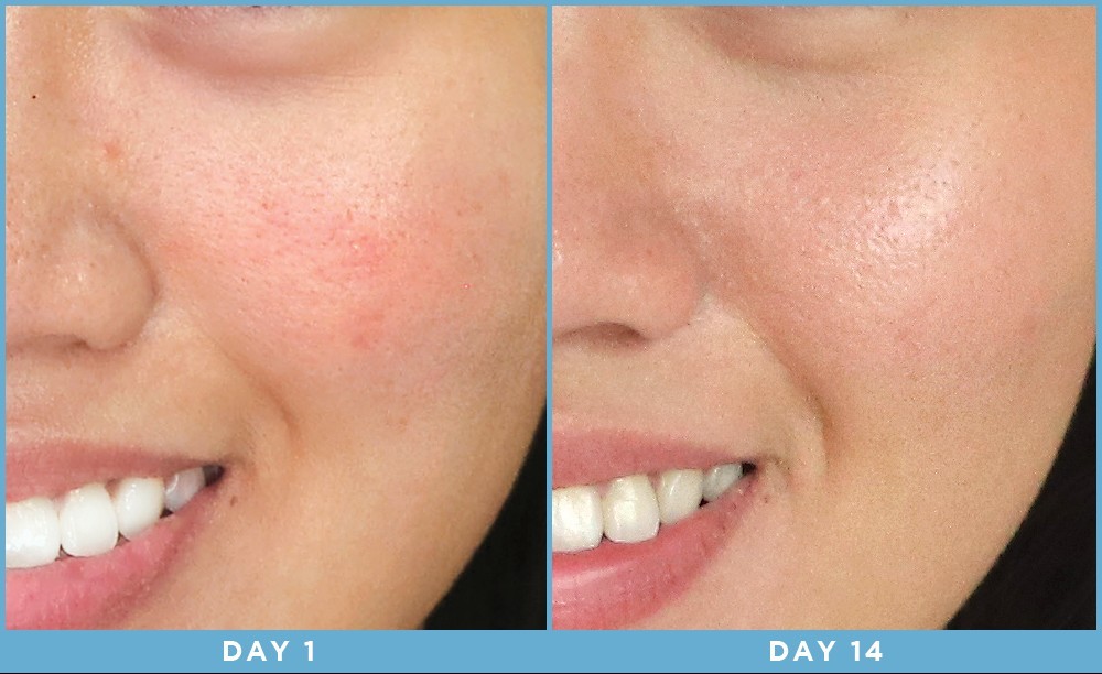 before and after light therapy for face