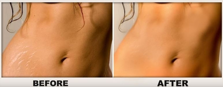 before and after light therapy treatment on abdomen