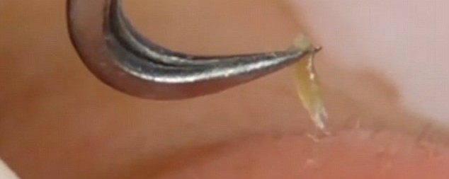 sebum extraction by dermatologist sebum extraction by dermatologist