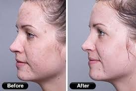 before and after treatment on light therapy