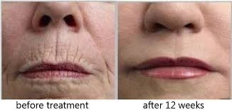 before and after treatment on skin wrinkles before and after treatment on skin wrinkles