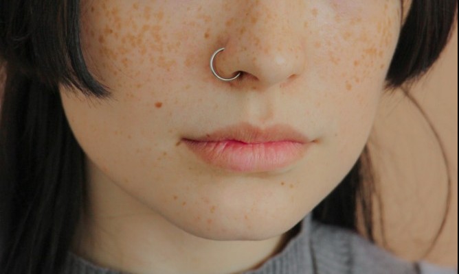 blackhead on face