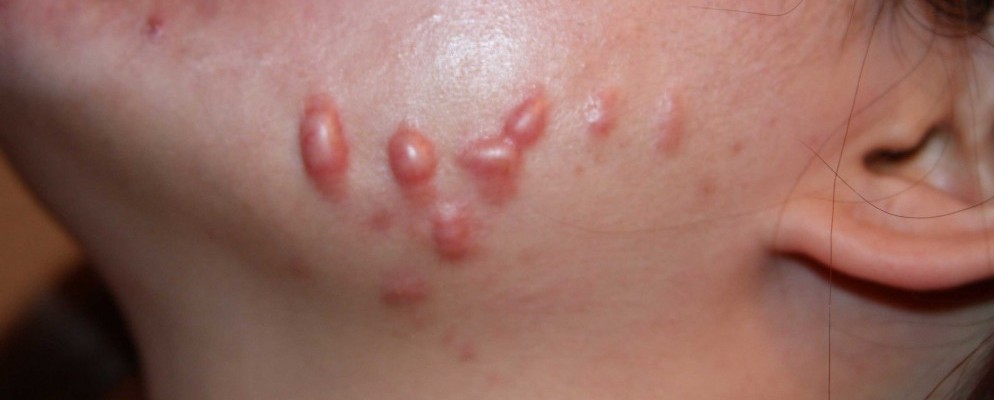 scary nodules on face