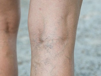 varicose veins on back of leg