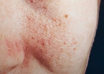 acne on face acne on face