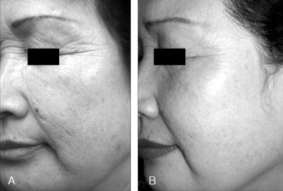 before and after infrared light therapy on face