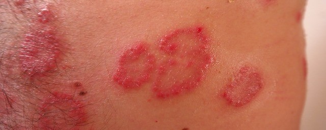 inflammation on legs