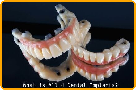 All 4 dental implants image