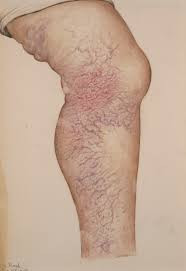 Varicose veins