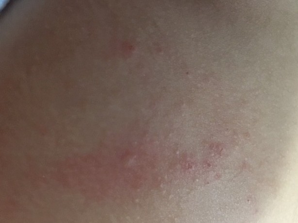 what causes eczema in babies
