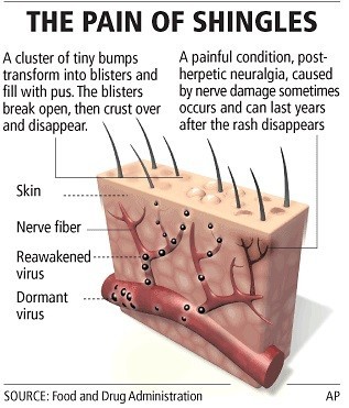 How Do I Know If I Have Shingles?