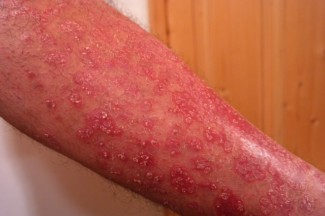 Do I have psoriasis or something else?