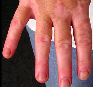 vitiligo vitiligo