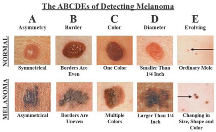 Abcde Cancer Chart