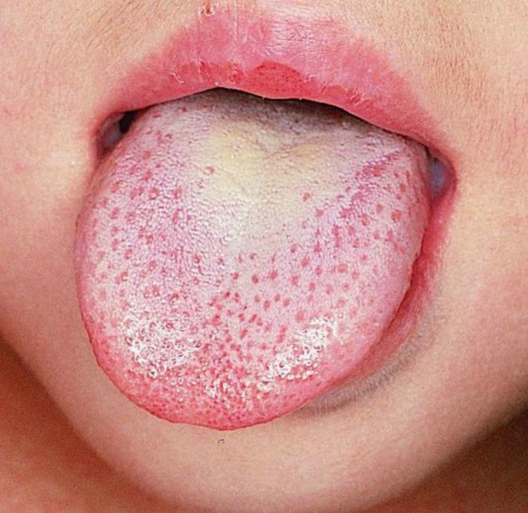 Tongue on white of bubble tip Painful burning