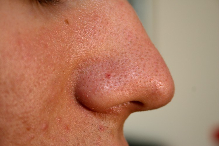 15 Natural Ways to Cure Skin Tags, Warts, and More