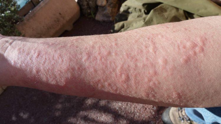 Can mosquito bites cause allergic reaction