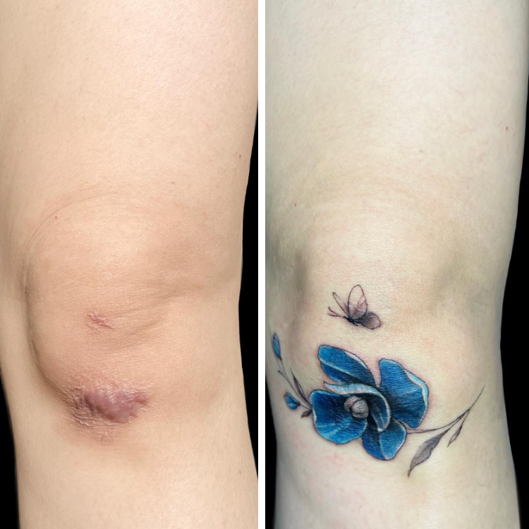 10 Times People Used Tattoos To Cover Up Their Scars — free download