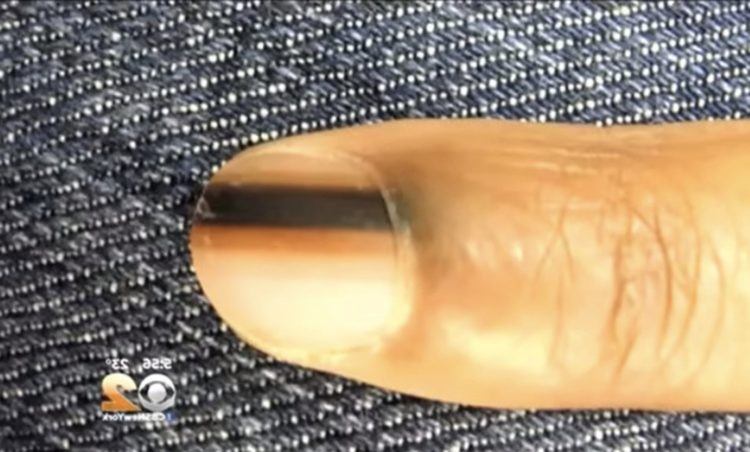 Here S Why You Should See A Doctor If You Notice Black On Your Nail