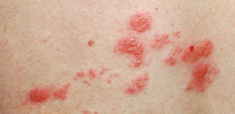 If You Get Shingles, You’ll Be Glad You Know About These 7 Natural Remedies