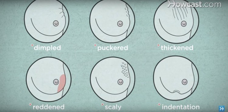 Breast Cancer Symptoms Everyone Needs to Know