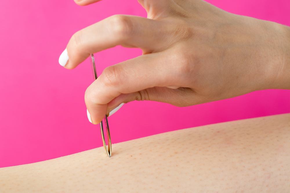 What To Do When You Have Ingrown Hair