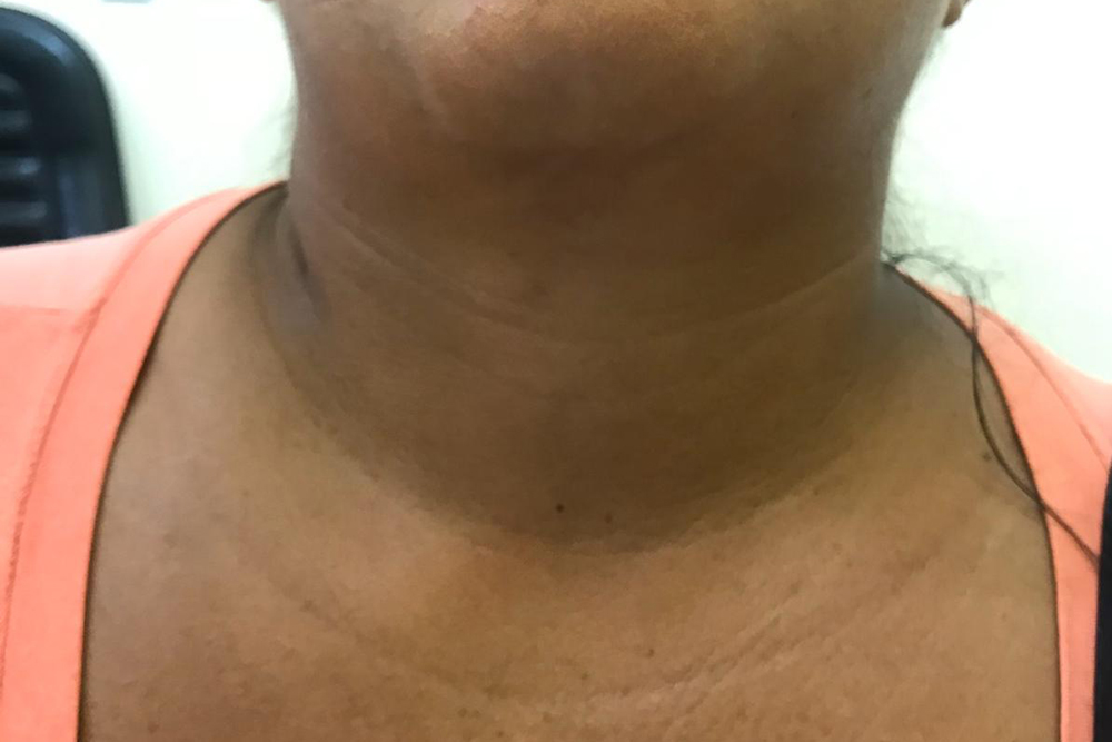 FCecon oferece cirurgia inovadora sem cicatriz contra câncer de