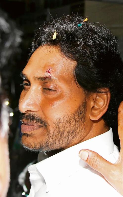How fatal is CM Jagan Mohan Reddy's Injury?