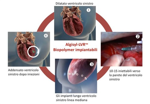 Trattamento con Algisyl