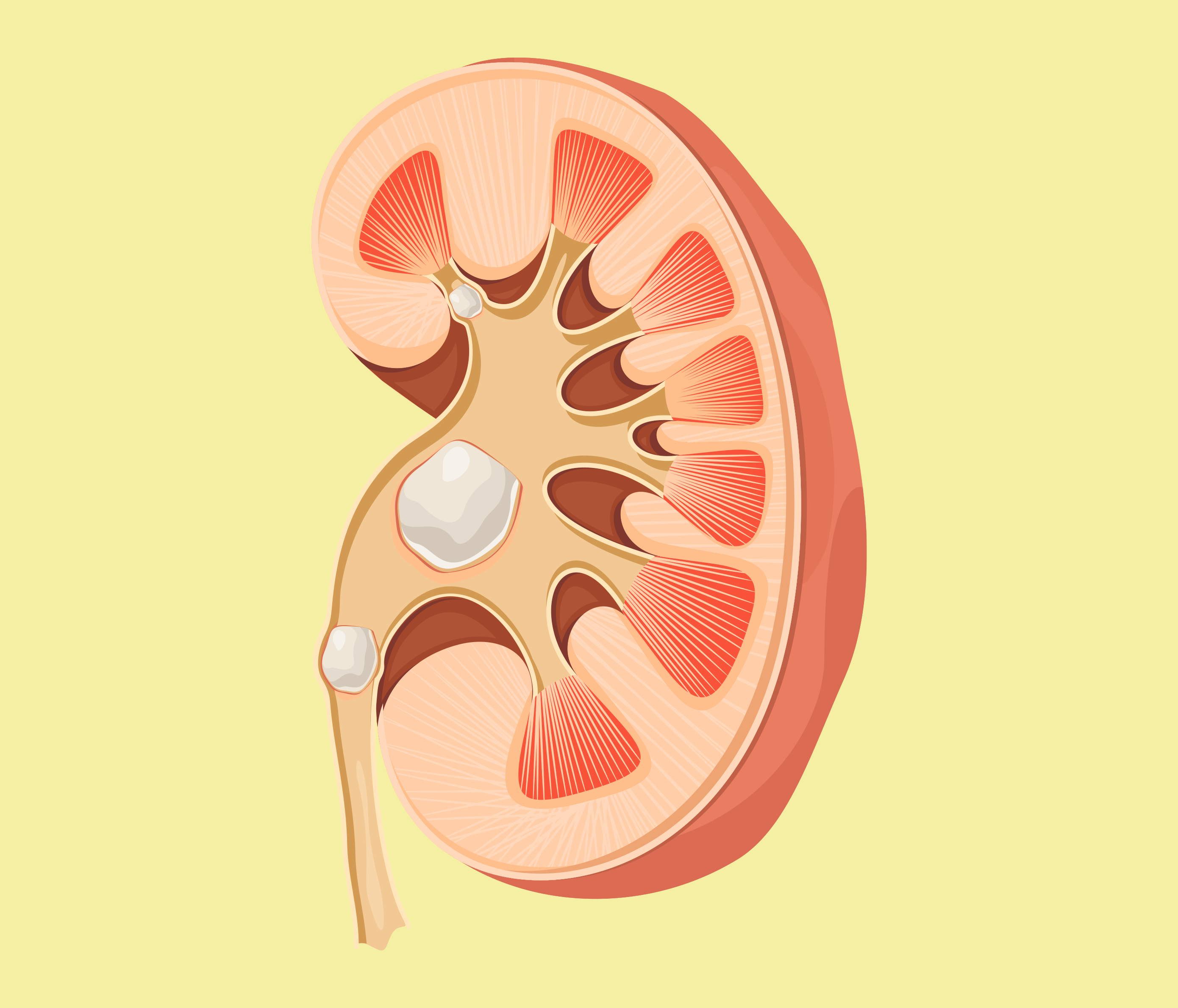 O que preciso saber sobre litíase renal (nefrolitíase ou o famoso