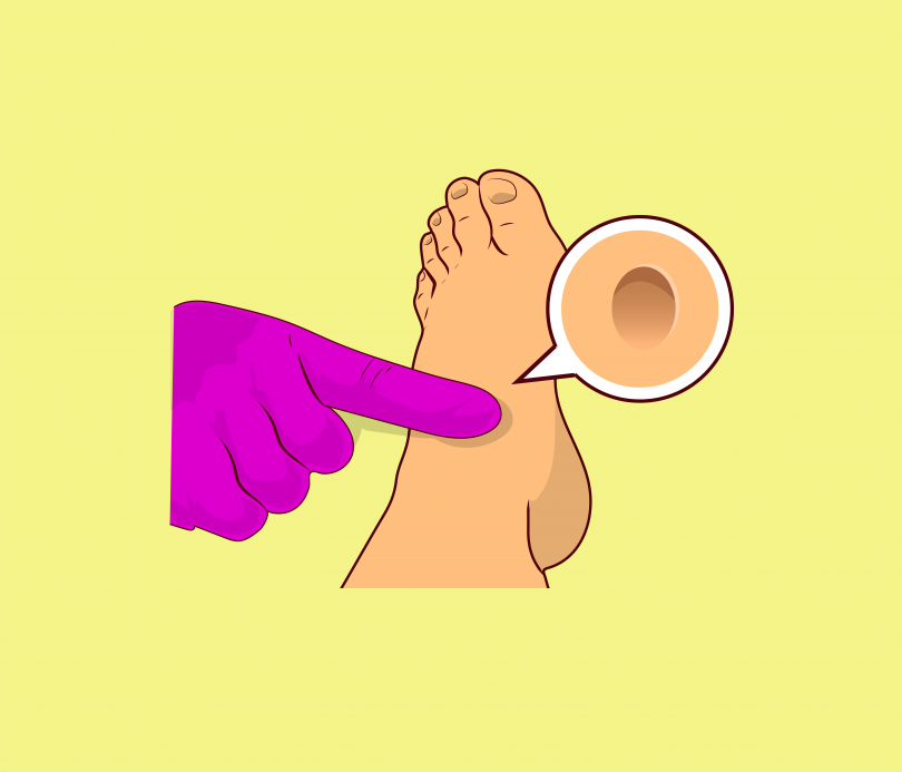 qual é a diferença entre anasarca e edema