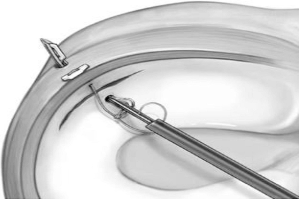 ZIMMER BIOMET Receives FDA Clearance of JuggerStitch™ Meniscal Repair