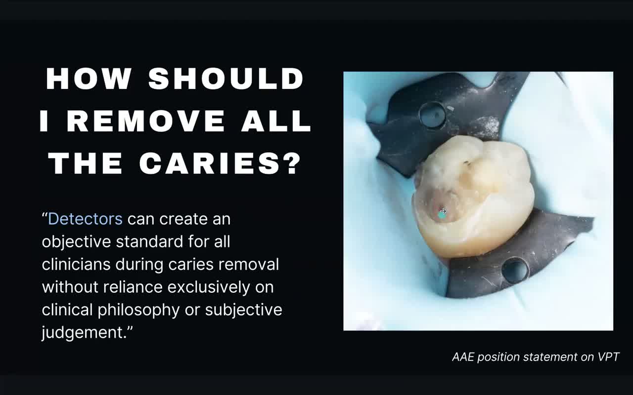 Pulp Capping Masterclass with Dr. Melissa Seibert