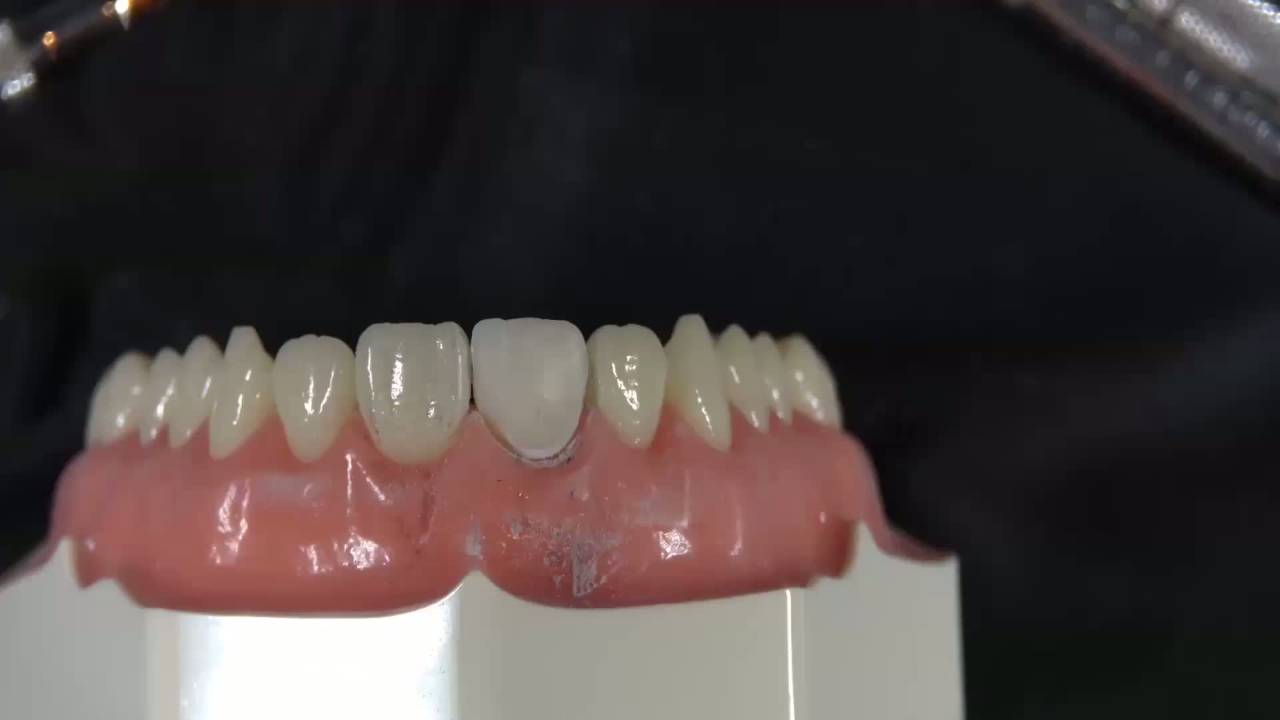 Composite Veneers Hands-On Demonstration with Dr. Dennis Hartlieb