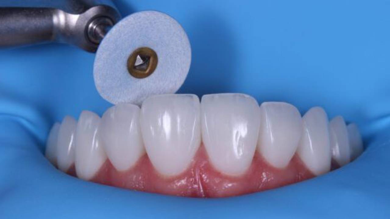Composite Veneers: Shape and Morphology with Dr. Dennis Hartlieb