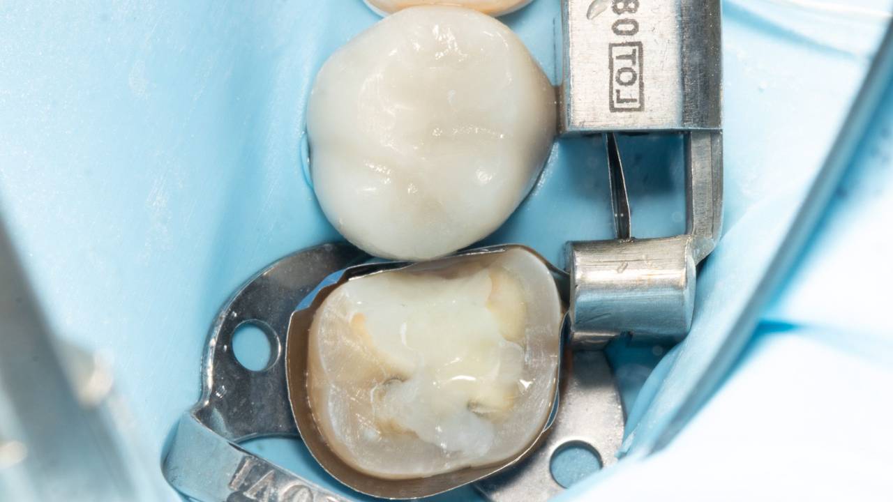 Deep Margin Elevation with Dr. Melissa Seibert