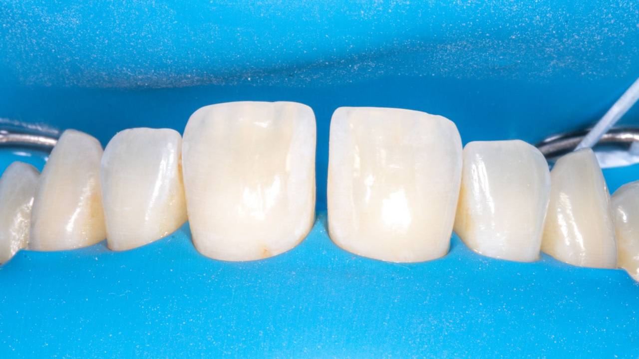 Diastema Closure with Resin Composite with Dr. Melissa Seibert