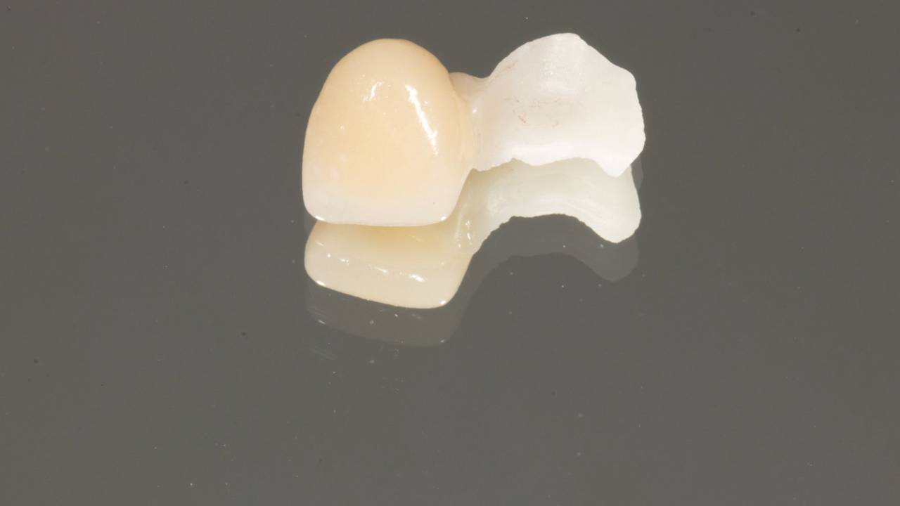 Resin Bonded Bridge (FDP) with Dr. Melissa Seibert
