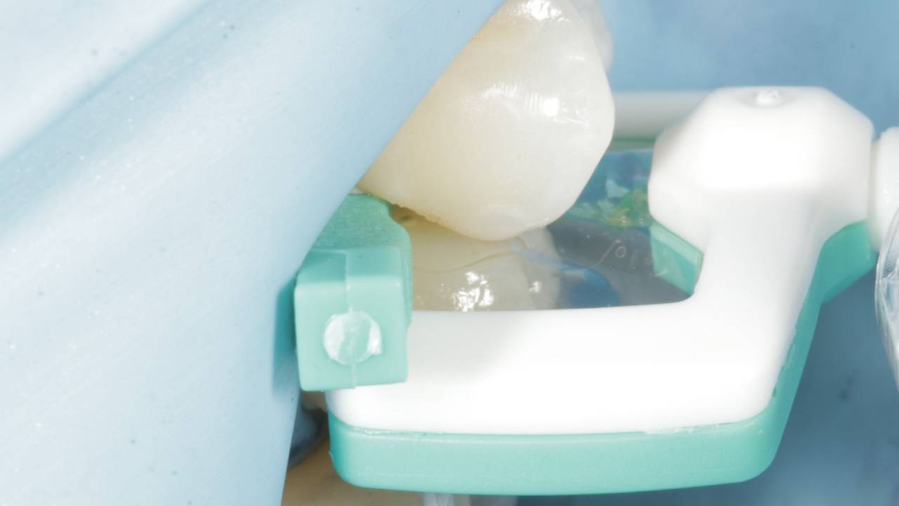 Resin Infiltration with Dr. Melissa Seibert