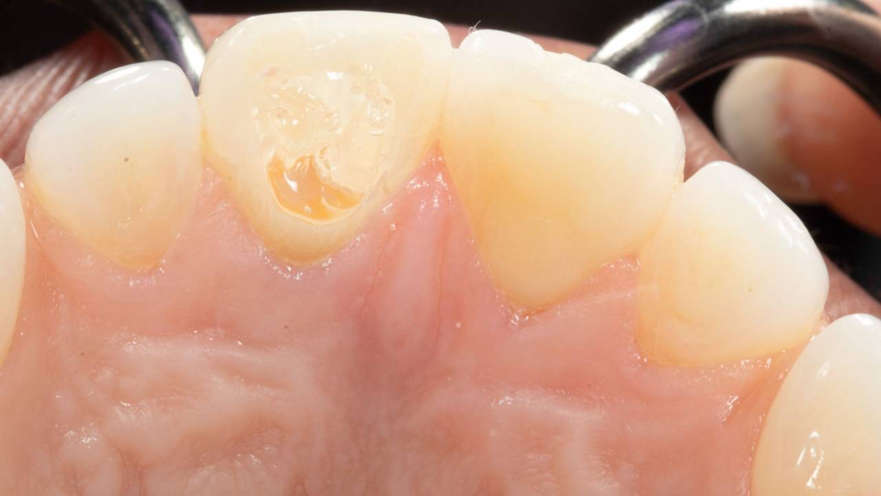 Internal Bleaching with Dr. Melissa Seibert