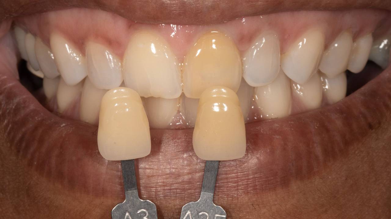 Foundation in Internal Bleaching with Dr. Melissa Seibert