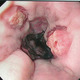 Esophageal_varices_-_post_banding.small