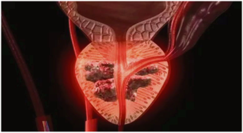 dolor en el pene después de una biopsia de próstata