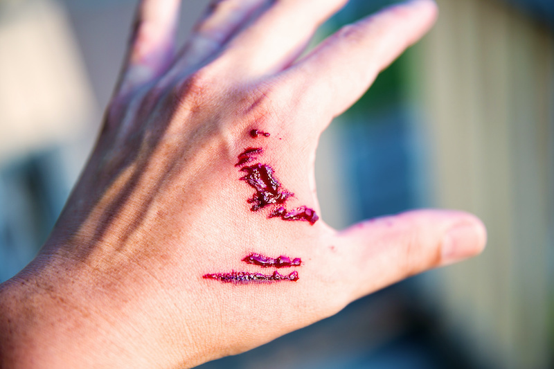Dog Bite Injury Lawsuit