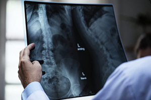 California Bulging and Herniated Disc Injury Lawyer