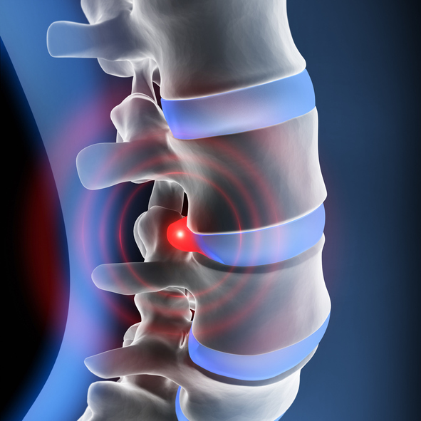 Herniated Discs From Car Accidents Labrum Law Firm