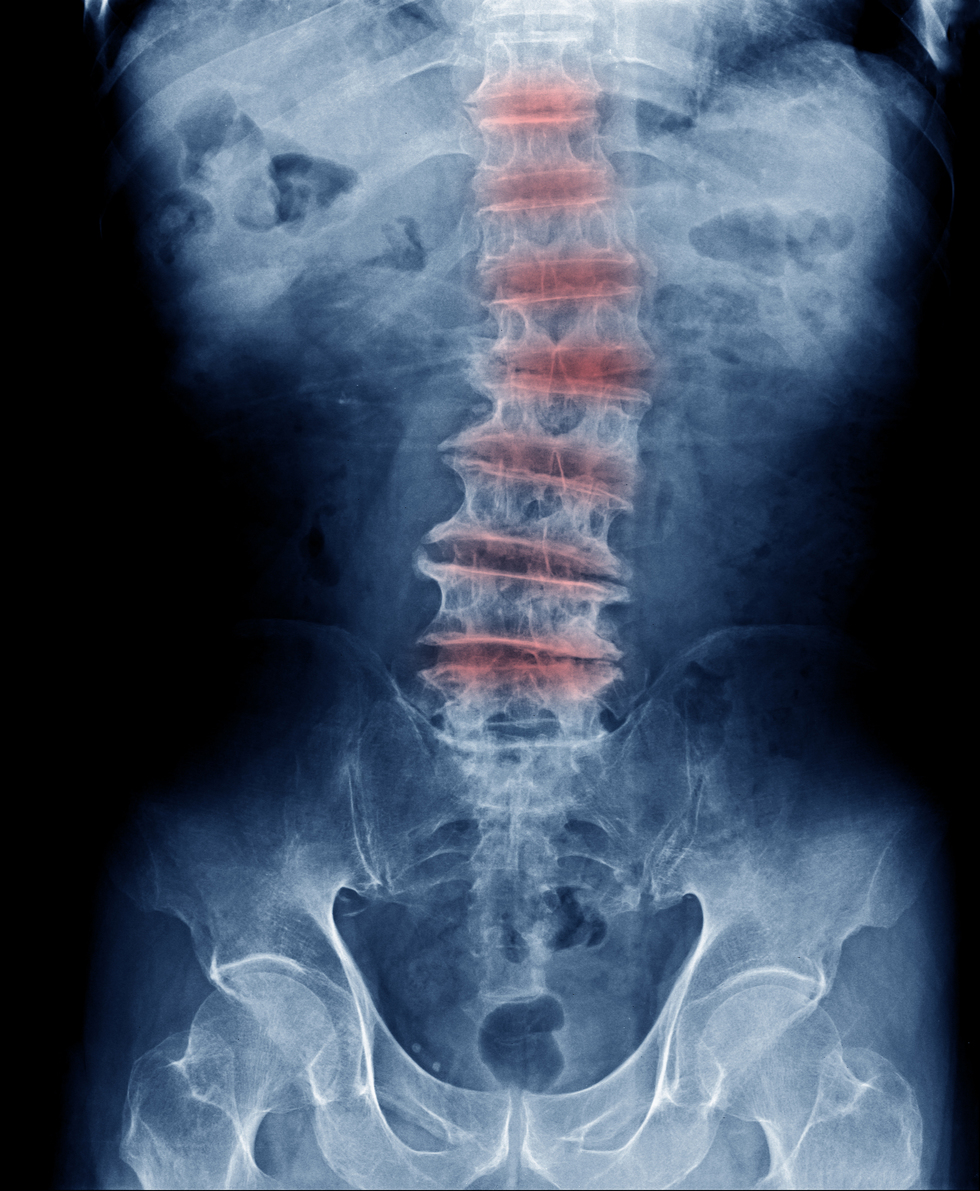 Can A Car Accident Cause Degenerative Disc Disease? Labrum Law