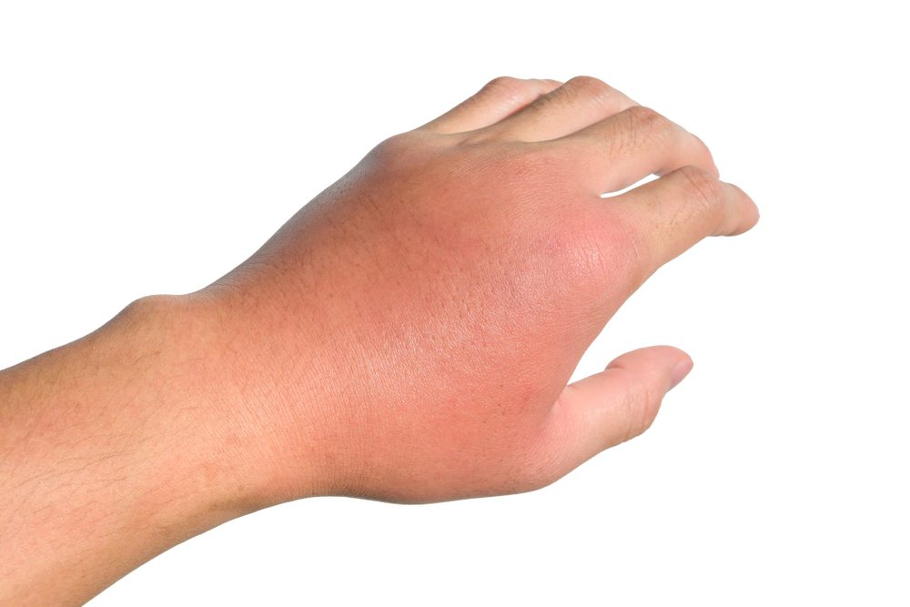 Warning Signs of Cellulitis and How to Prevent It | Life360 Tips
