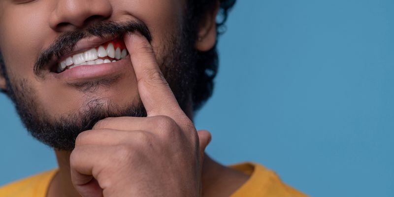 Mouth bacteria trigger rheumatoid arthritis by breaking into the blood