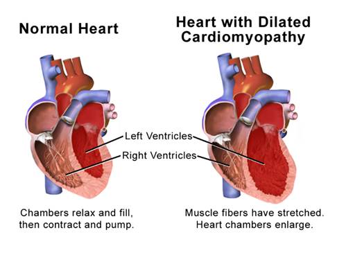 Image result for cardiomyopathy